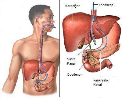 Gallbladder Removal In Turkey