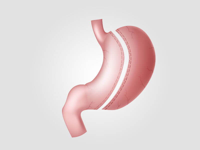 Gastric Sleeve