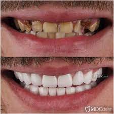 Zirconium Crowns in Turkey