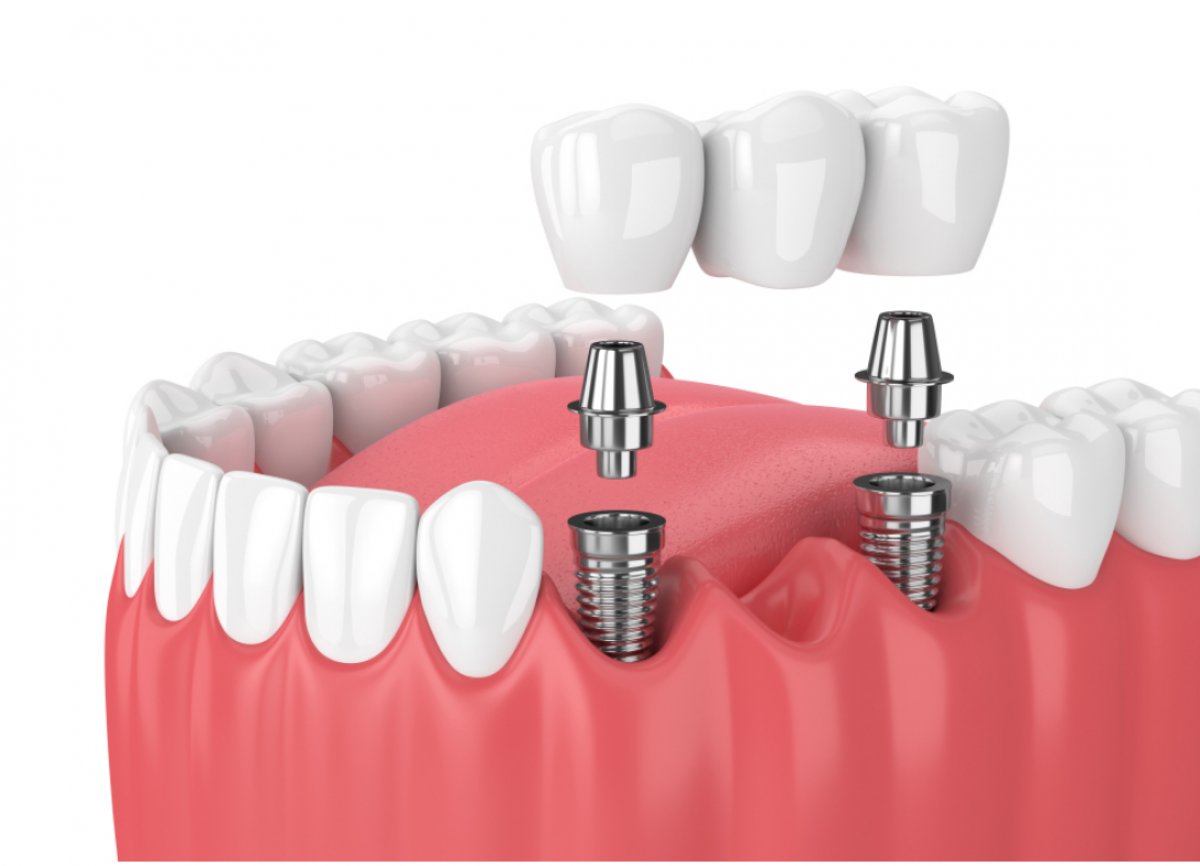 Dental Implants