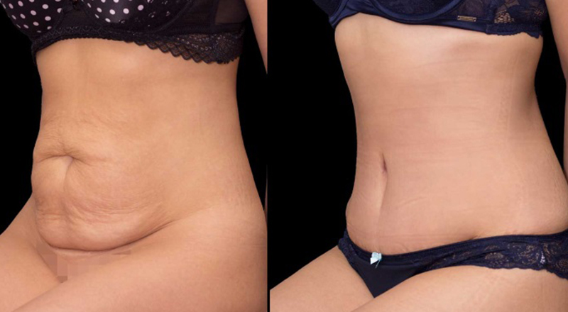 Tummy Tuck