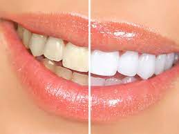 Teeth Whitening in Turkey